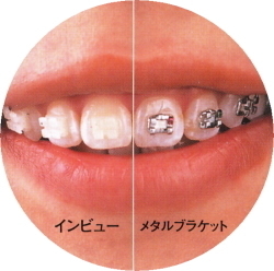 セラミックブラケット - 神谷歯科クリニック （富士市）